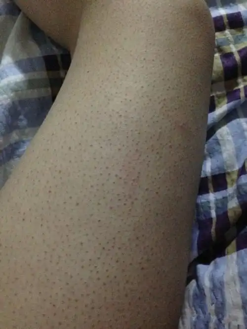 天生鸡皮肤图片_有来医生