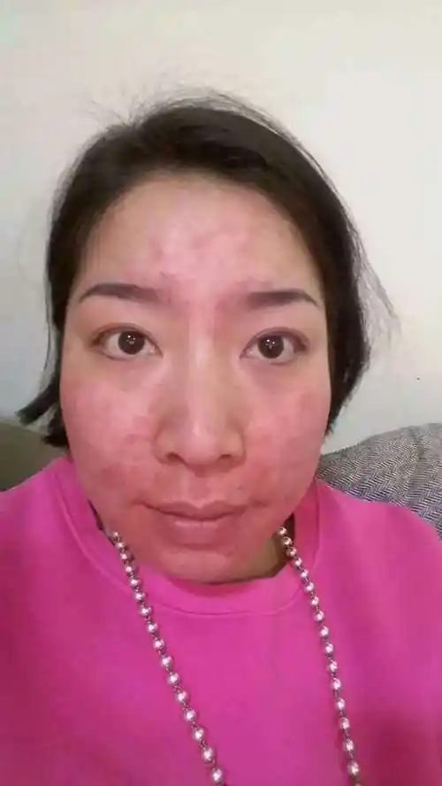 你的脸是皮肤过敏还是激素依赖性皮炎?_手机搜狐网