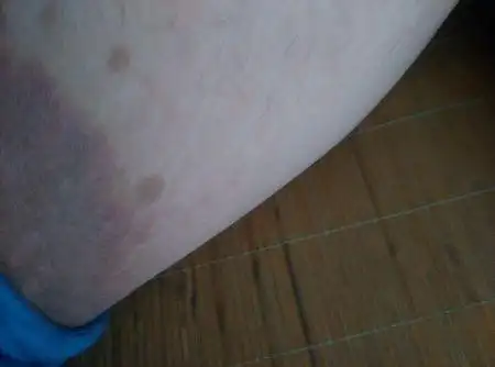 大腿胯两侧比较黑,呈黑褐色怎么回事,洗澡也拿沐浴露擦好像擦不掉