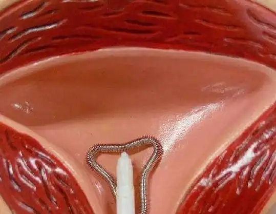 上环避孕虽然方便,但对女性的这三个伤害却不容忽视,看后很心疼_东方