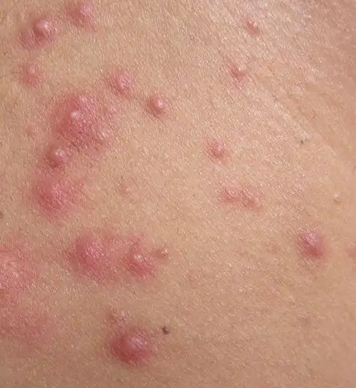 背上的"红痘痘"也是青春痘吗?丨郭波