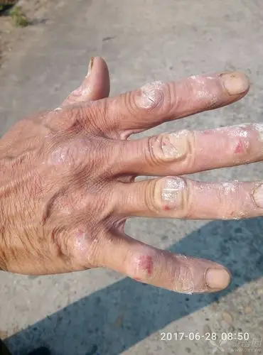 手关节发痒,流黄水,特痒,什么问题啊!各位老师帮忙看看.用什么药!