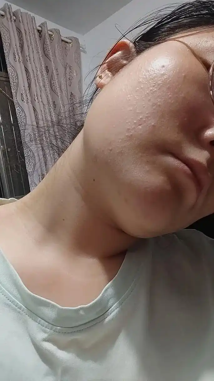 闭口油性皮肤都很管用 - 抖音