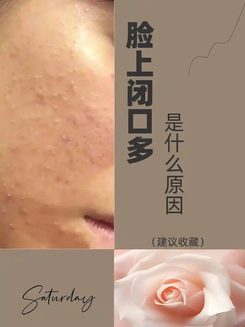 闭口是因为屏障受损吗?无论我们有#闭口粉刺 还是#闭口痘痘  - 抖音