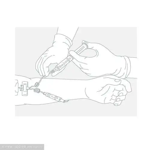 单线图解图解说明输液治疗通过肌肉注射药物,针或导管做单线风格.