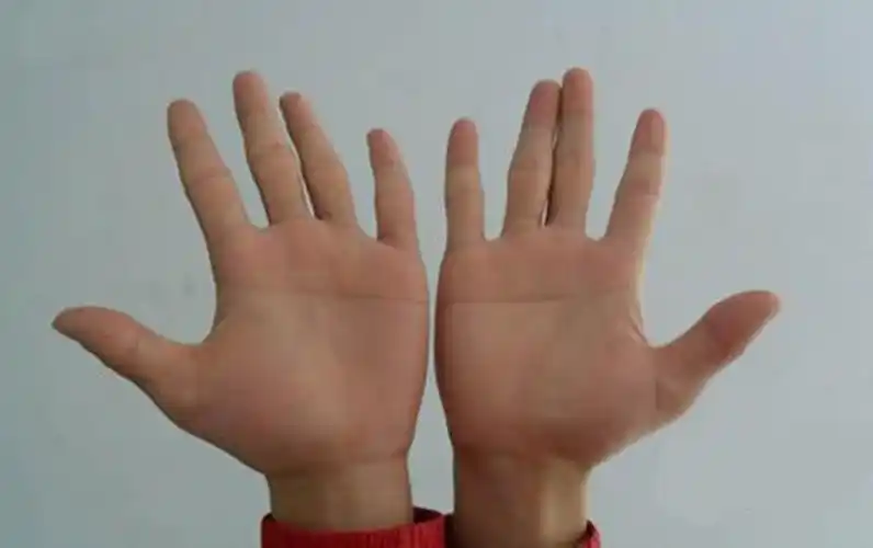 唐氏综合症特征图片_有来医生