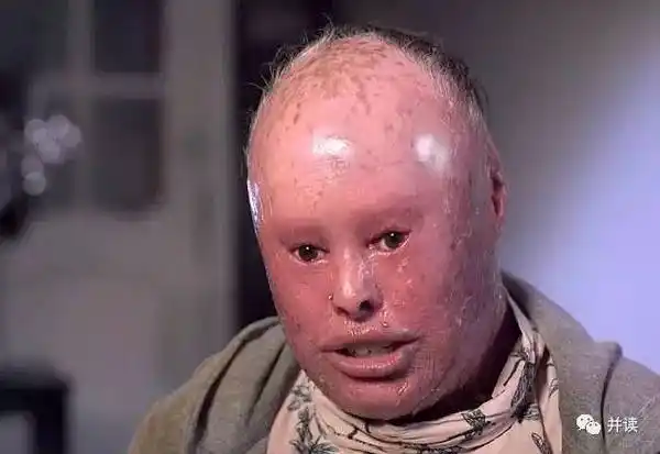 斑色鱼鳞癣是一种罕见的遗传性皮肤病,患者皮肤的生长速度是正常人的