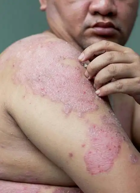 百度皮肤病图片识别常见皮肤癣图片牛皮藓病初期症状图片牛皮屑早期