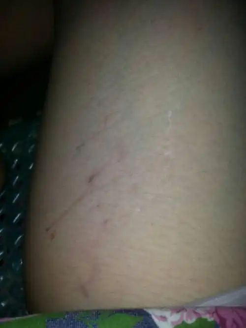 在大腿内侧跟大腿上面都有,不痒,形状就像一条小蛆一样,有白