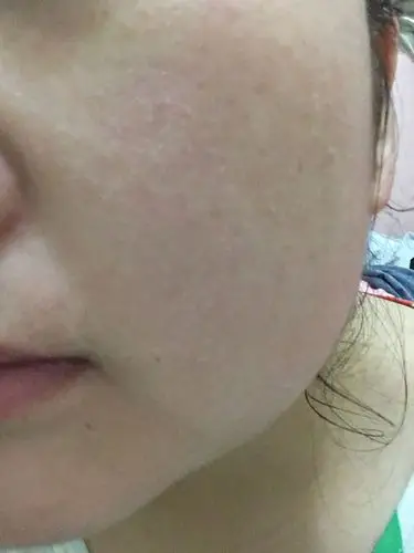 问:洗脸后皮肤紧绷,起皮,很干,而且还会痒,很难受 如果摸了水和乳液