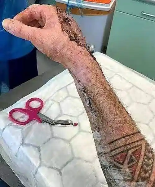 吃人的细菌:食肉菌到底有多恐怖?