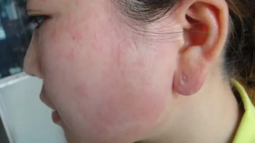 看图诊病-《春季皮肤病病例征集》