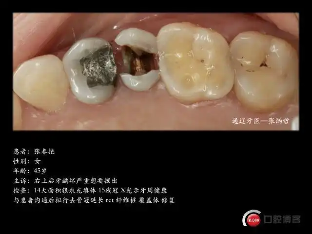 两颗双尖牙的死与生