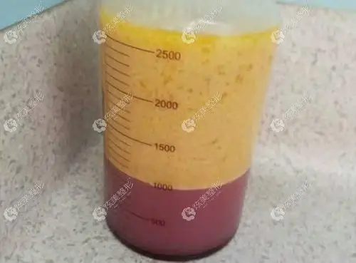 2000ml脂肪不管是全身抽脂还是单部位抽脂都能做