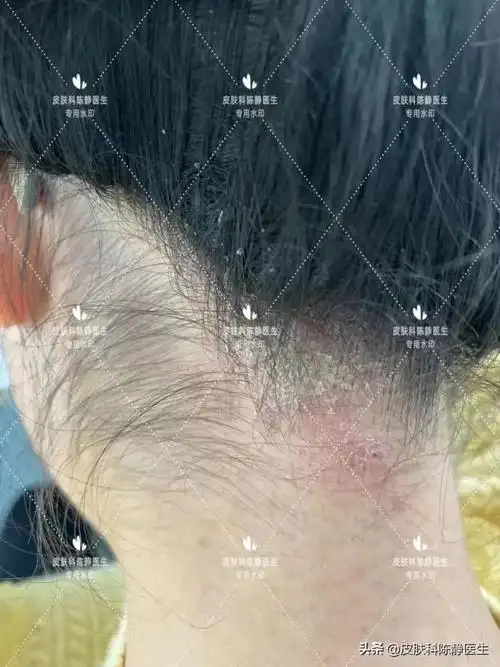 困扰几亿人的特殊湿疹脂溢性皮炎