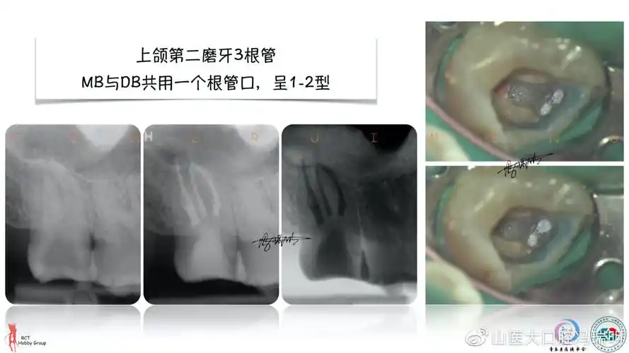 上颌第二磨牙根管解剖形态特点及病例分享
