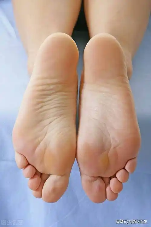 脚心发热患者一例