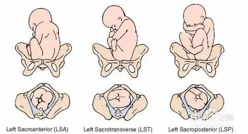 多种胎位图 - 母婴育儿