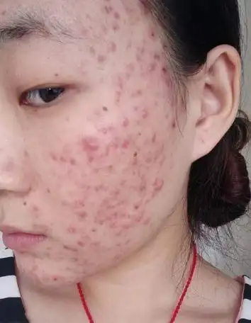 女人湿气重,减肥难满脸痘,甩掉一身湿更瘦更年轻