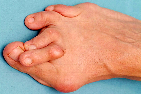 美丽的高跟鞋还是健康的大脚!