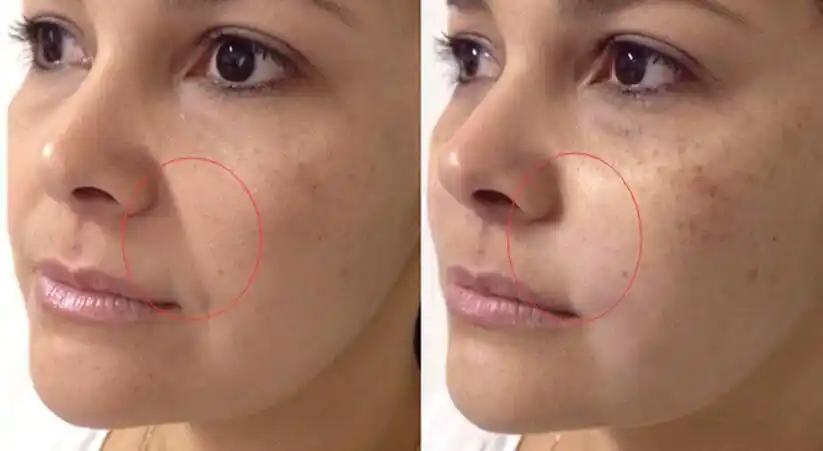 fotona4d极塑提拉面部治疗3次前后对比