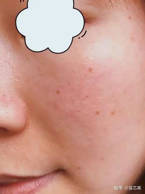 脸上角质层薄特别容易脸红怎么办有好用的护肤品么