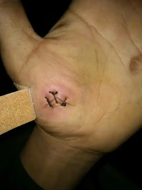 手上被刀划就缝了三针多长时间拆线