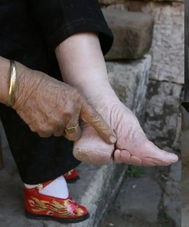封建时期的三寸金莲对幼儿好残忍,好好的一双脚被裹得只剩两根大脚趾.