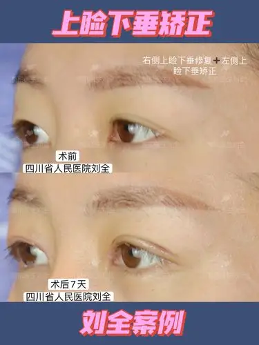 上睑下垂术后七天