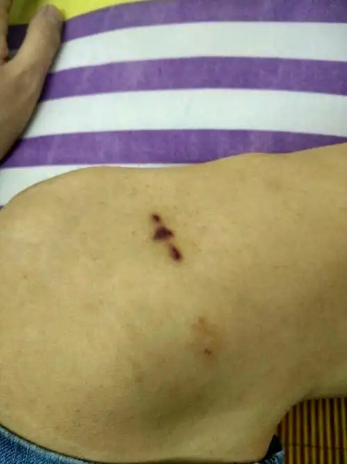 手术后,伤口愈合,但颜色发黑,怎么回事?