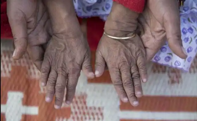 印度姐弟患怪病 皮肤褶皱似老人