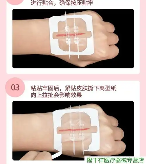拉链式创可贴减张贴减张力器伤口贴免缝合缝针式疤痕皮肤术后创口一包