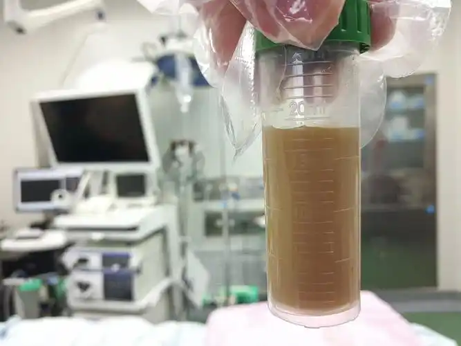 于鹏飞—— 做的ebus-tbna ,纵隔淋巴结穿刺出液性坏死.