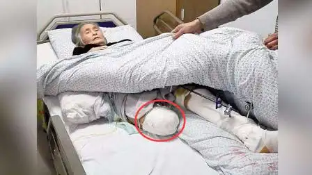 医院做完截肢手术后,病人的断肢是如何处理的?