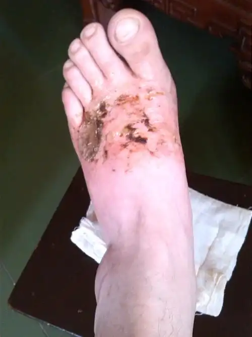 昨天开水烫伤左脚面,起了大水泡.水泡破了的脚面有点肿