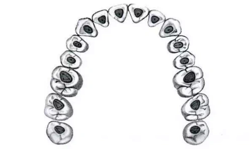 其它 上颌第一磨牙根管治疗流程 写美篇一,根管口颌面解剖形态 以下是