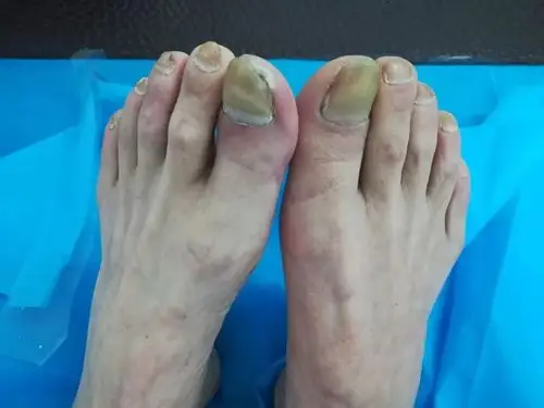 天冷腿脚疼警惕一类病治晚了轻者截肢重则丢命