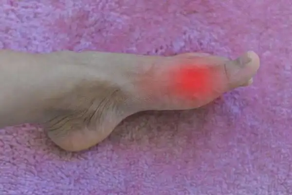 脚酸是痛风的症状吗痛风尿酸降下来了为什么脚还会痛