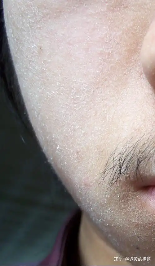 很多人一到秋冬,脸上就会明显的看到很多"皮屑",这种其实并非角质层的