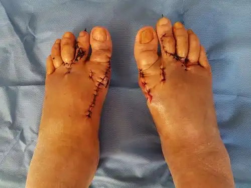 骨六科重度拇外翻并第2趾交叉趾畸形的治疗