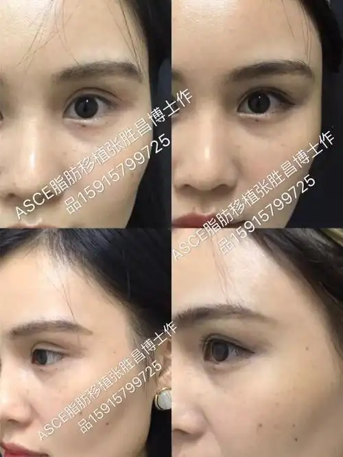 真实案例丨填个眼窝竟然有修复双眼皮的效果