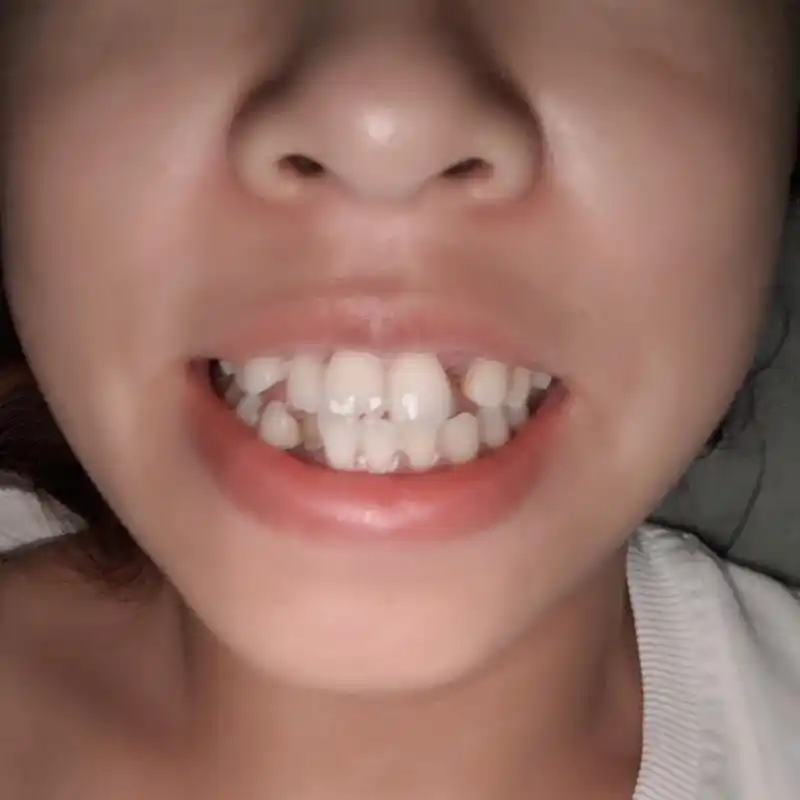 龅牙虎牙嘴部前突导致脸型都变了一口牙毁掉整张脸