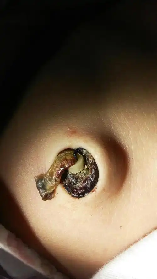 宝宝第8天了,脐带不但没掉还有血是怎么回事呢只看楼主