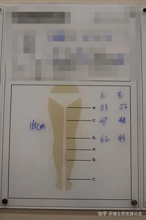 大腿吸脂纯脂肪2500cc腿围能瘦多少啊?