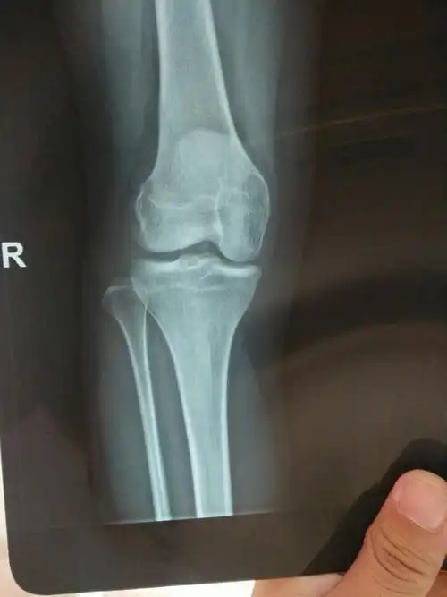 有专家能看出来我膝盖间隙有什么异样吗?