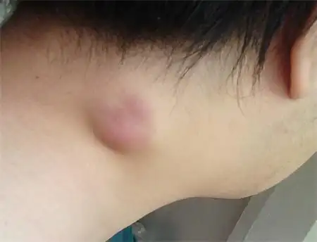 【腋下淋巴肿大图片】_症状_原因_苹果绿