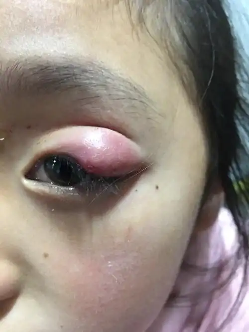 本人临床上见此疾病,一般不早期予以切开排脓.