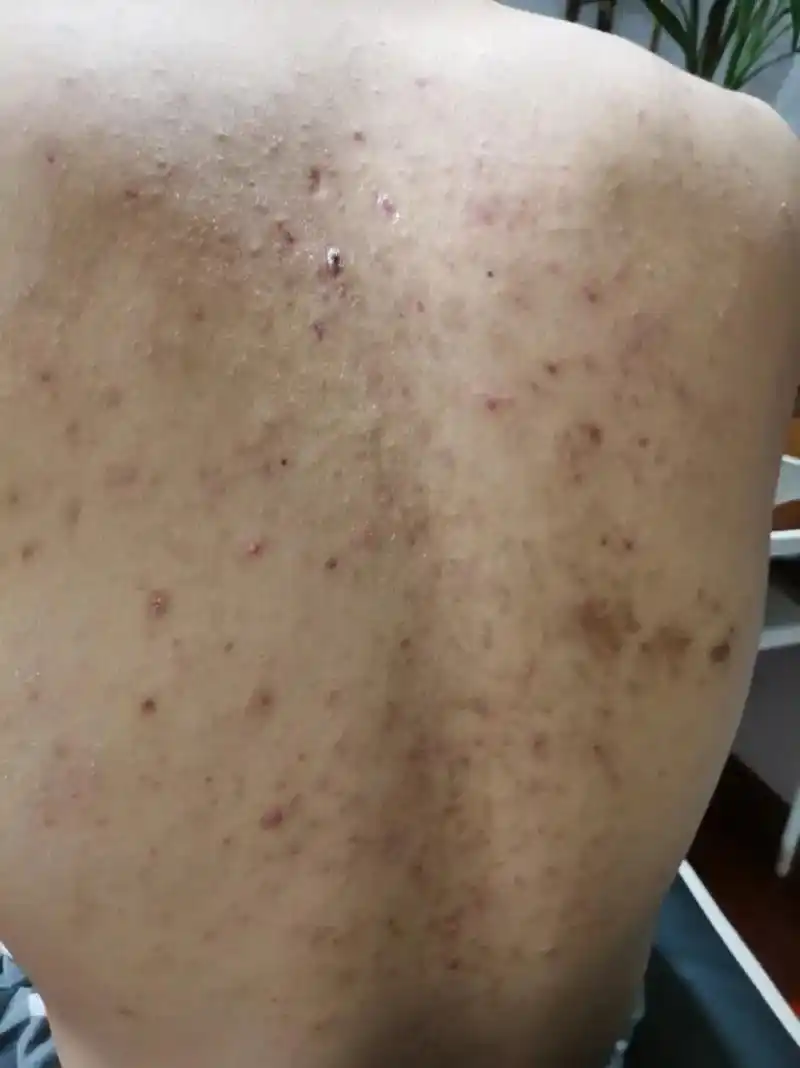 背部长痘痘闭口粉刺黑头