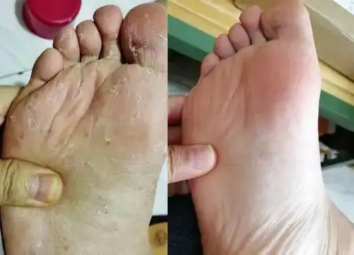 烂脚丫脚痒脚臭有脚气不要扣过来人支你2招彻底消灭足部真菌