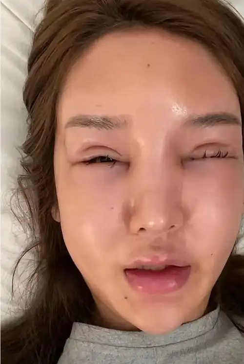 整容上瘾的桃花宝宝毁容网友看着让人害怕